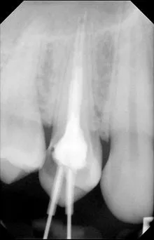 Endodoncja – leczenie kanałowe